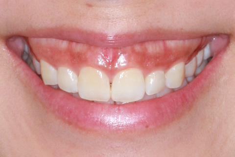 歯肉形成（形成）症例1（電気メスによる歯肉形成）治療前