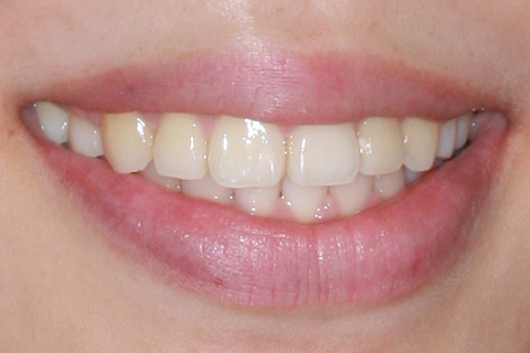 歯肉形成（形成）症例6（インプラント矯正で治療）治療後
