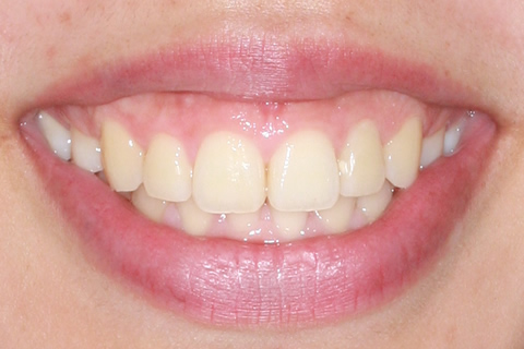 歯肉形成（形成）症例6（矯正用アンカースクリューで治療）治療前