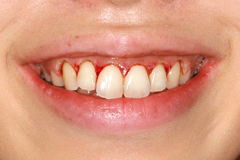 歯肉形成（形成）症例3（電気メスによる歯肉形成）治療後