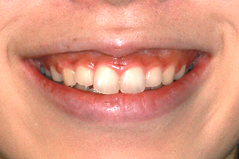 歯肉形成（形成）症例3（電気メスによる歯肉形成）治療前