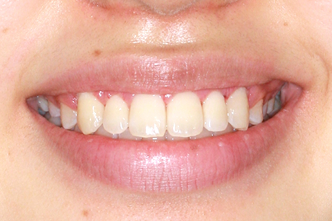 歯肉形成（形成）症例4（電気メスによる歯肉形成）治療後