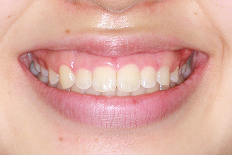 歯肉形成（形成）症例4（電気メスによる歯肉形成）治療前