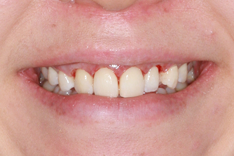 歯肉形成（形成）症例5（電気メスによる歯肉形成）治療後