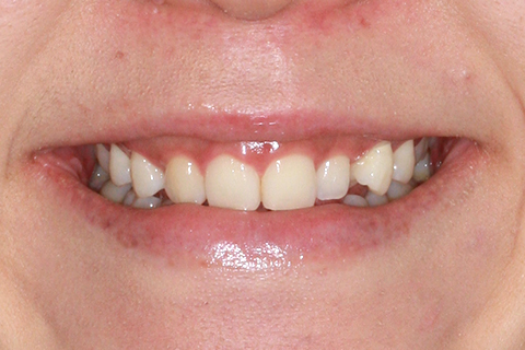 歯肉形成（形成）症例5（電気メスによる歯肉形成）治療前