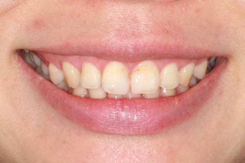歯肉形成（形成）症例2（電気メスによる歯肉形成）治療後