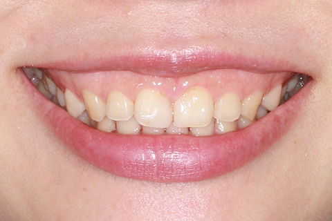歯肉形成（形成）症例2（電気メスによる歯肉形成）治療前